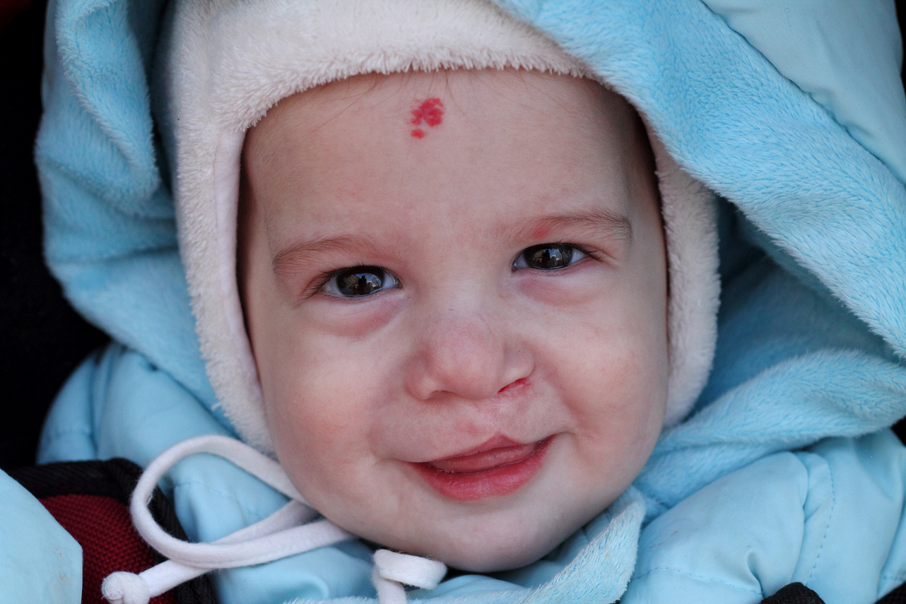 Laughing child with lip cleft